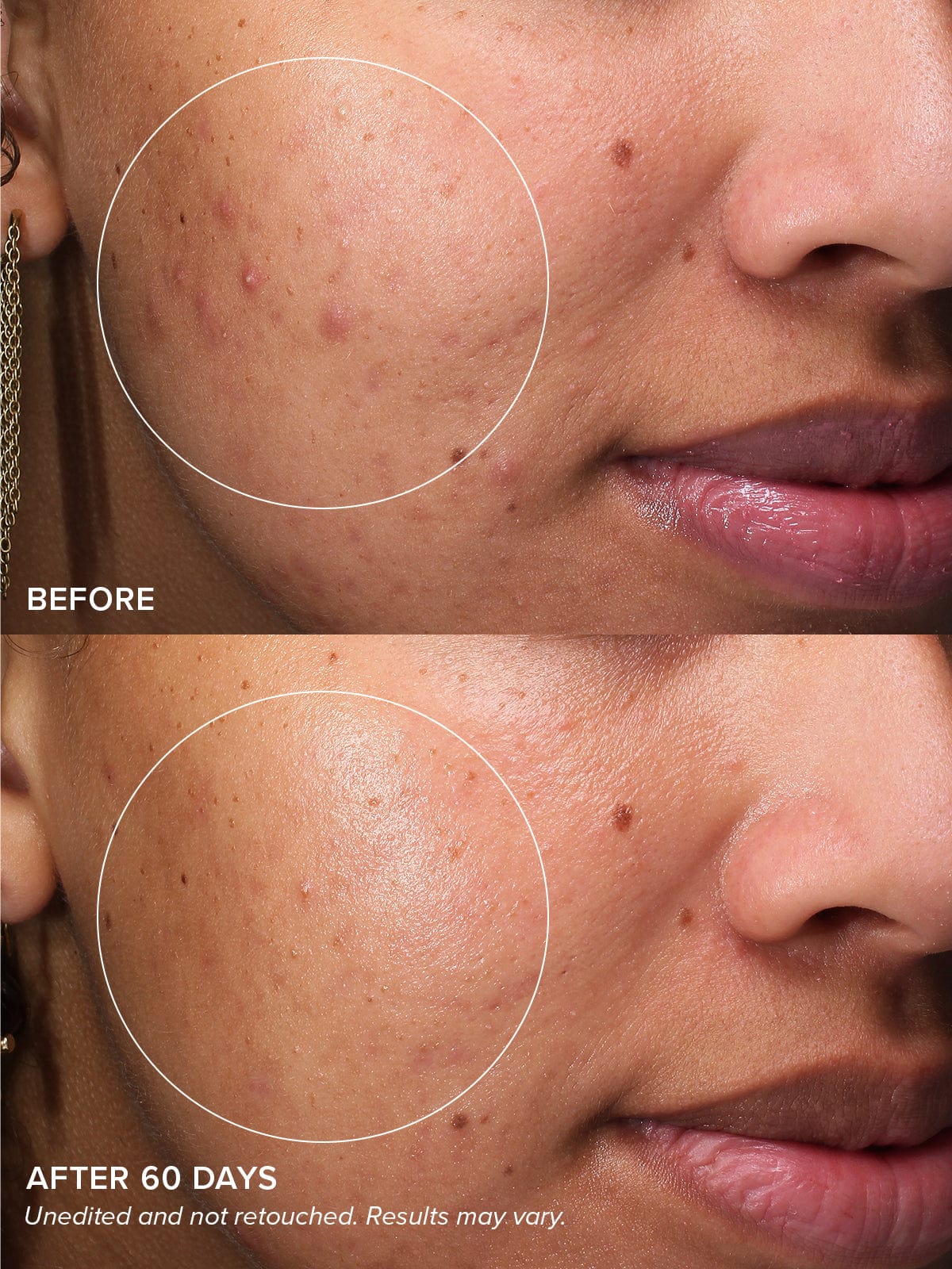 Gentle Acne Kit - Image 3